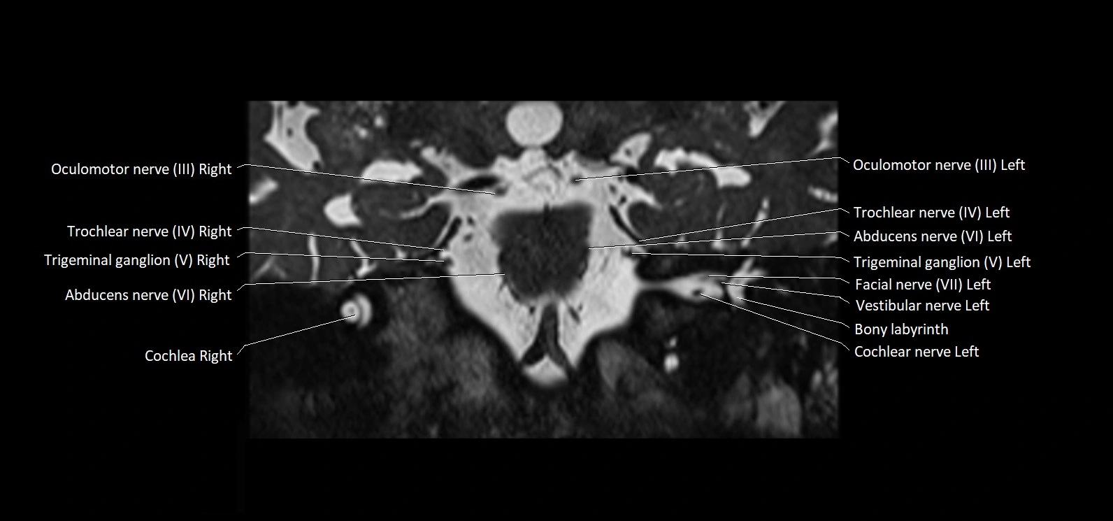 Cranial nerve cross sectional anatomy coronal 3T MRI image 38.webp